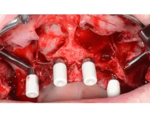 Final surgical view zygoma