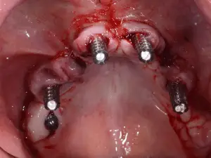 Surgical view zygoma