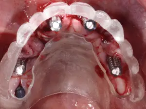 Surgical guide zygoma