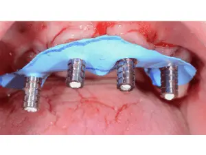 Pickup prosthesis zygoma