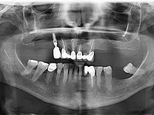 pre-operative OPG zygoma