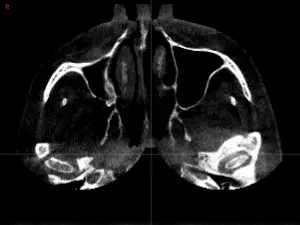 Sinus status CBCT