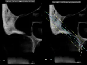 CT cut for zygoma planning