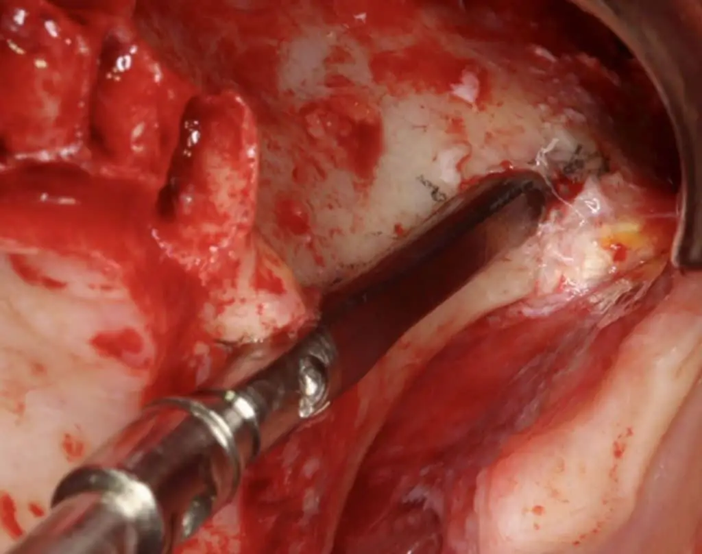 Zygomatic implant surgery ZAGA by Dr Carlos Aparicio