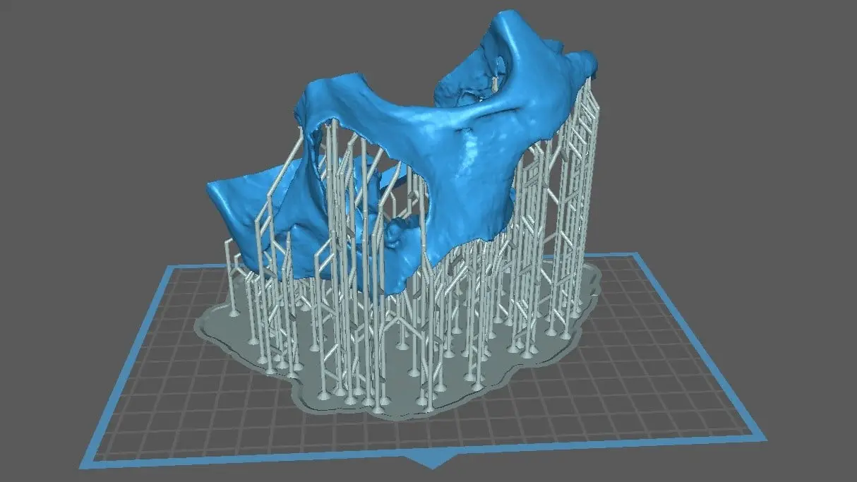 3D dental model for zygomatic implants STL files