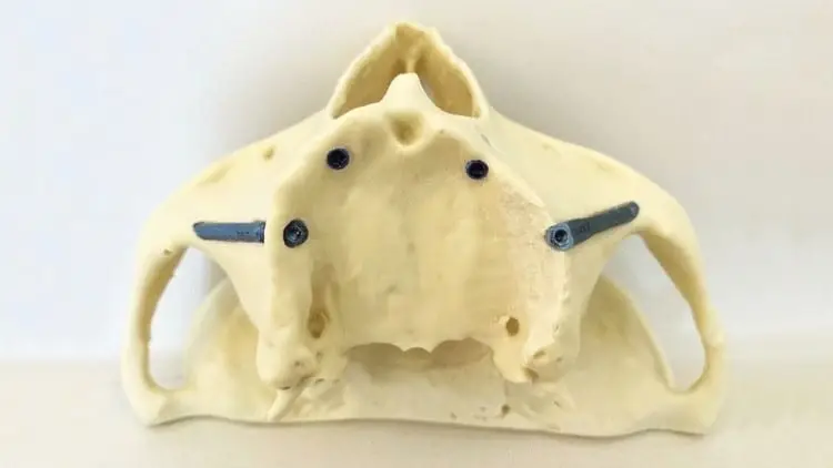 3D dental model for zygomatic implants