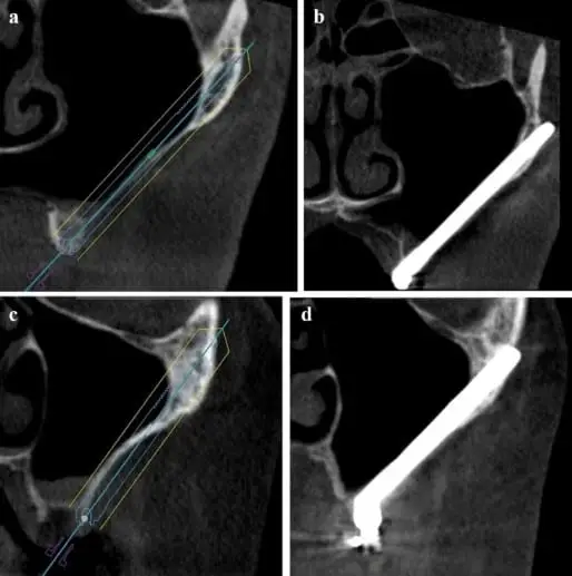 ZAGA approach CBCT scanner