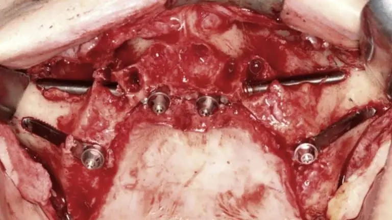 Round and flat zygomatic implants