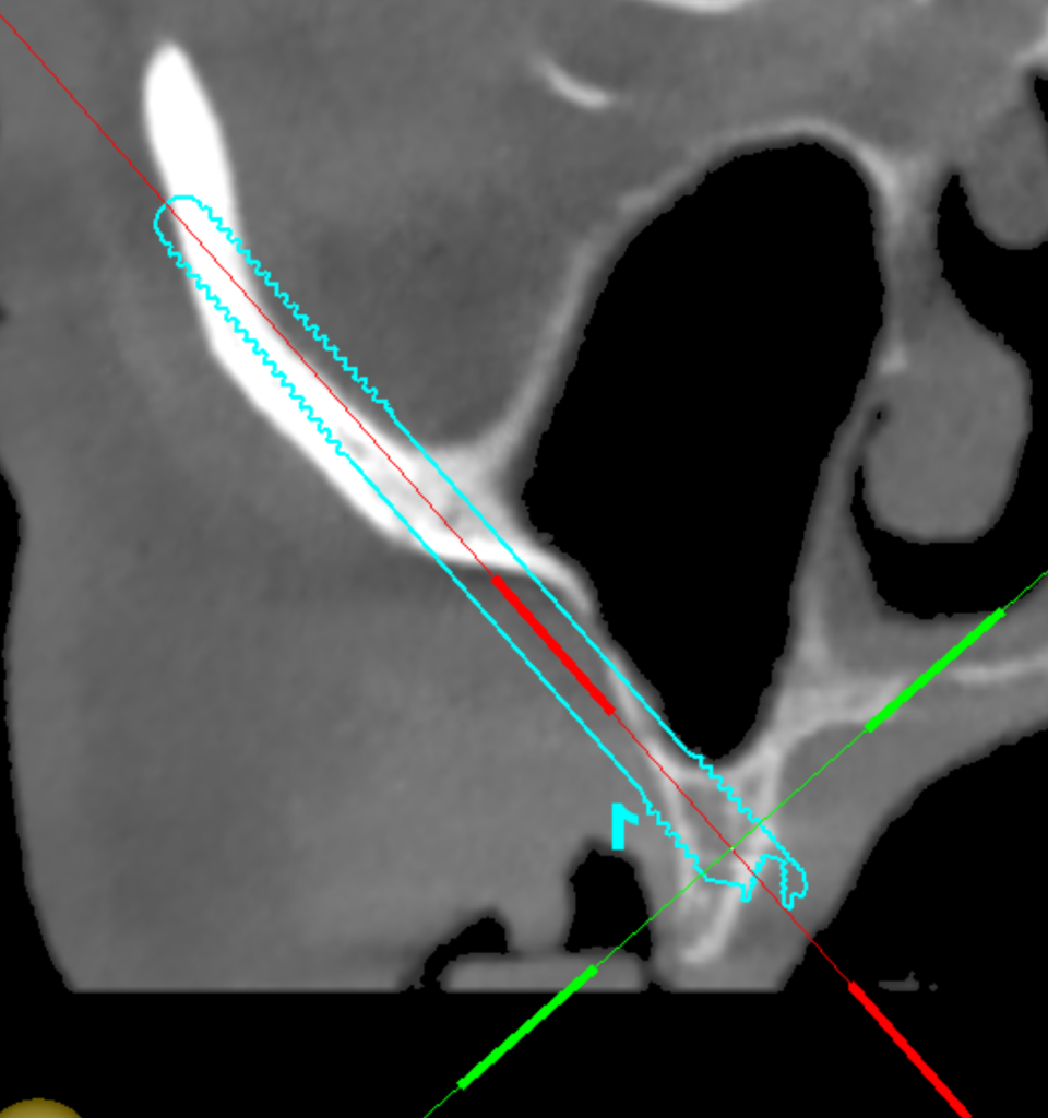 Virtual Zygomatic Implant