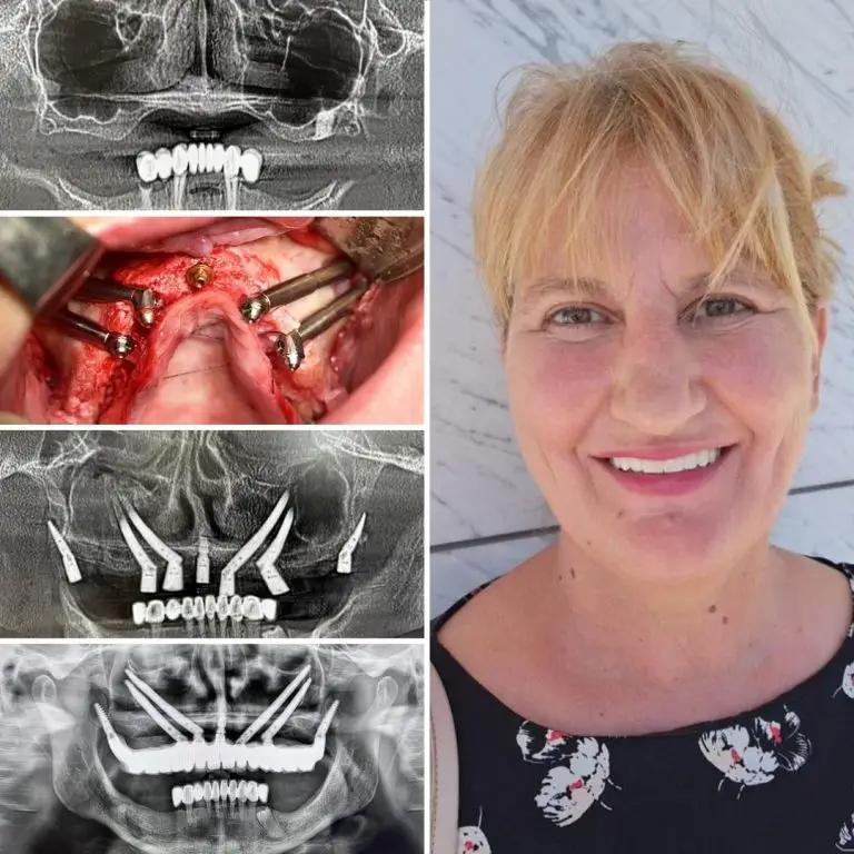 Patient with fixed dentures - quality of life study by Smile24h