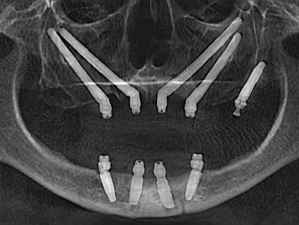 Result of one of the live surgeries