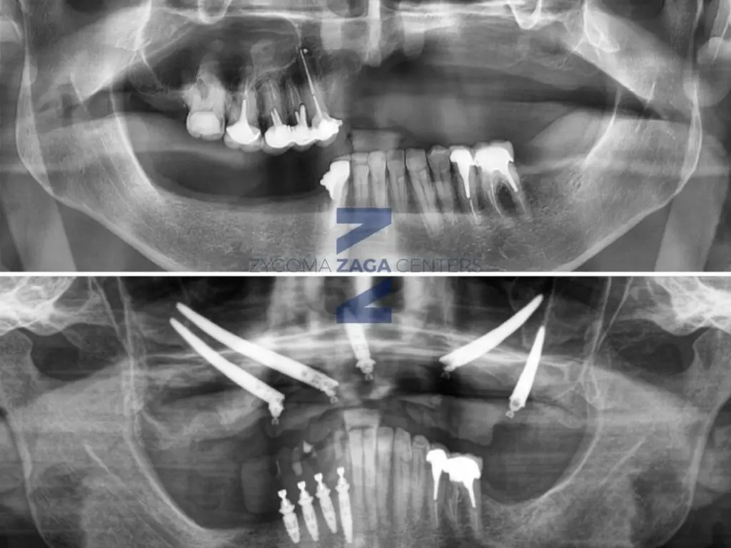 Zygomatic Case Report by Dr Russo ZAGA Center Paris
