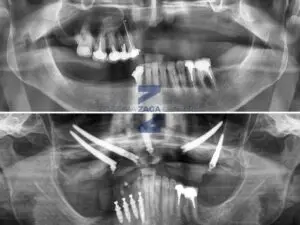 Zygomatic Case Report by Dr Russo ZAGA Center Paris