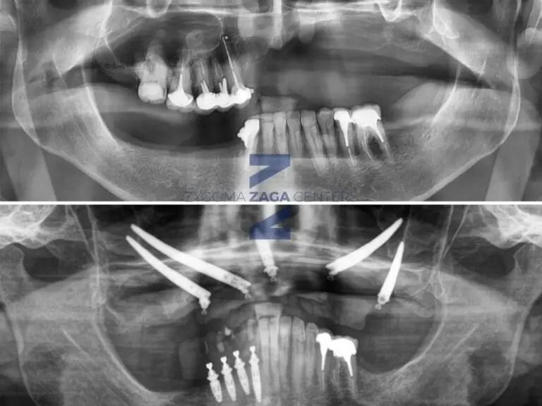 Zygomatic Case Report by Dr Russo ZAGA Center Paris