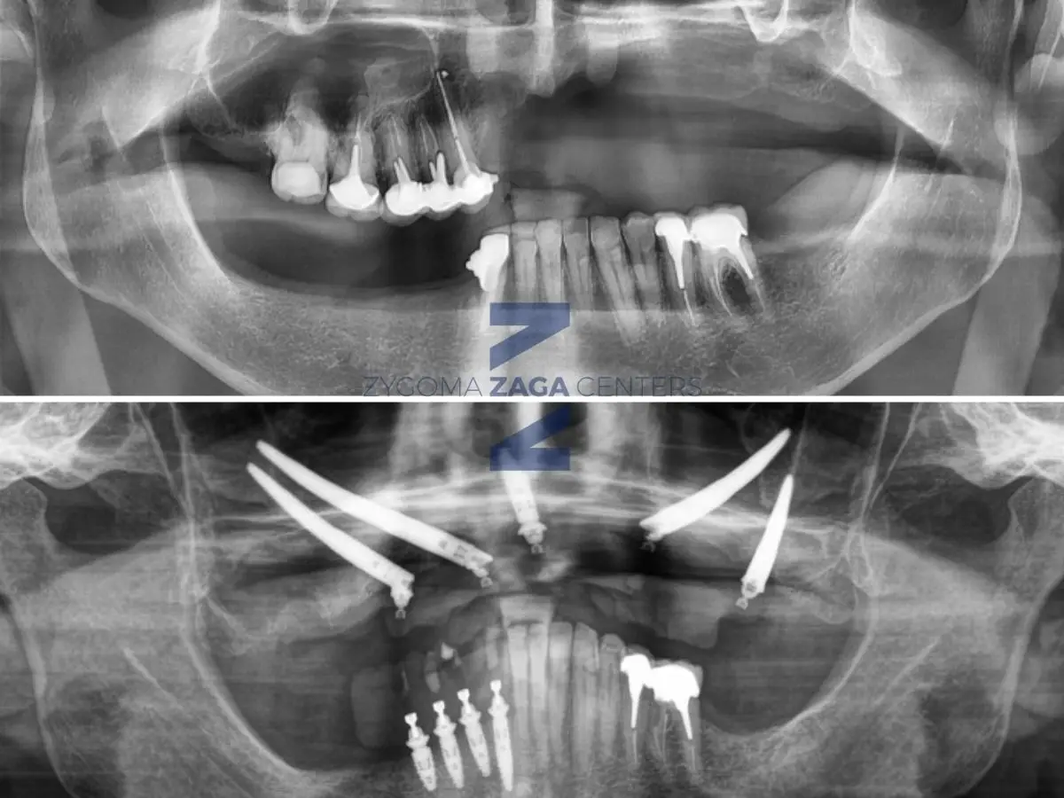 Zygomatic Case Report by Dr Russo ZAGA Center Paris