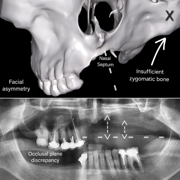 Severe bone atrophy with maxillary asymmetry