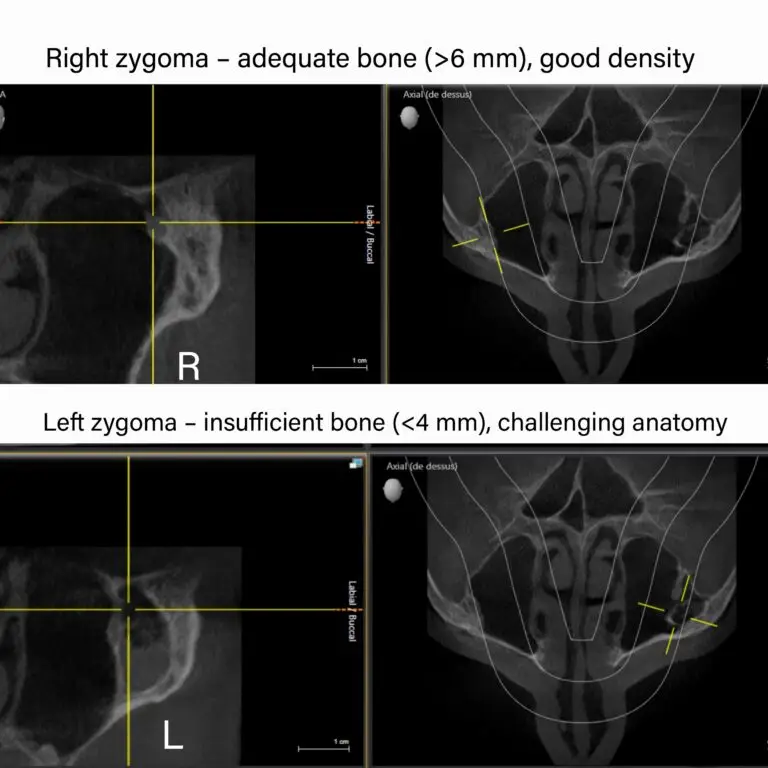 Significant Zygomatic Volume Asymmetry
