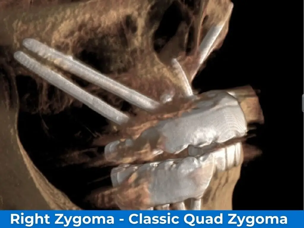 Right Zygoma - Classic Quad Zygoma