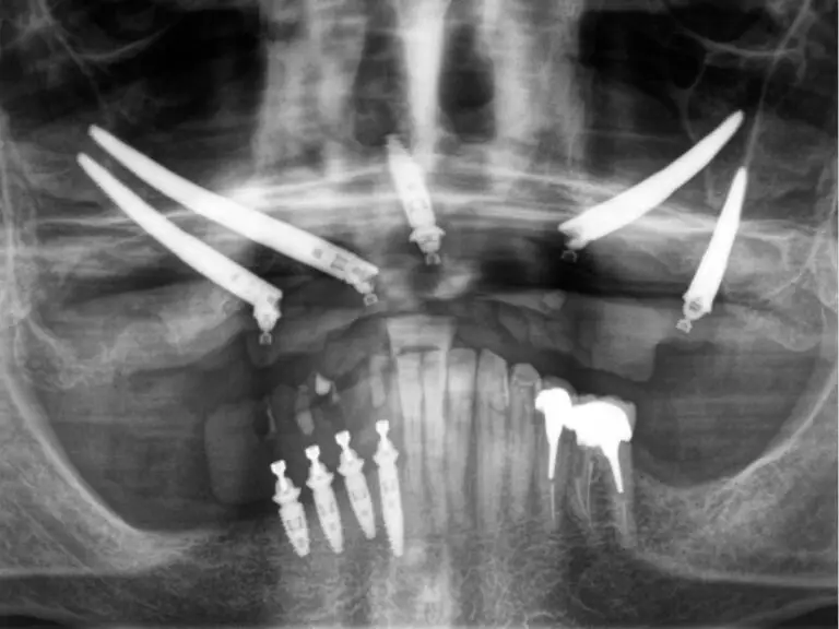 Zygomatic Implants by Dr. Umberto Russo