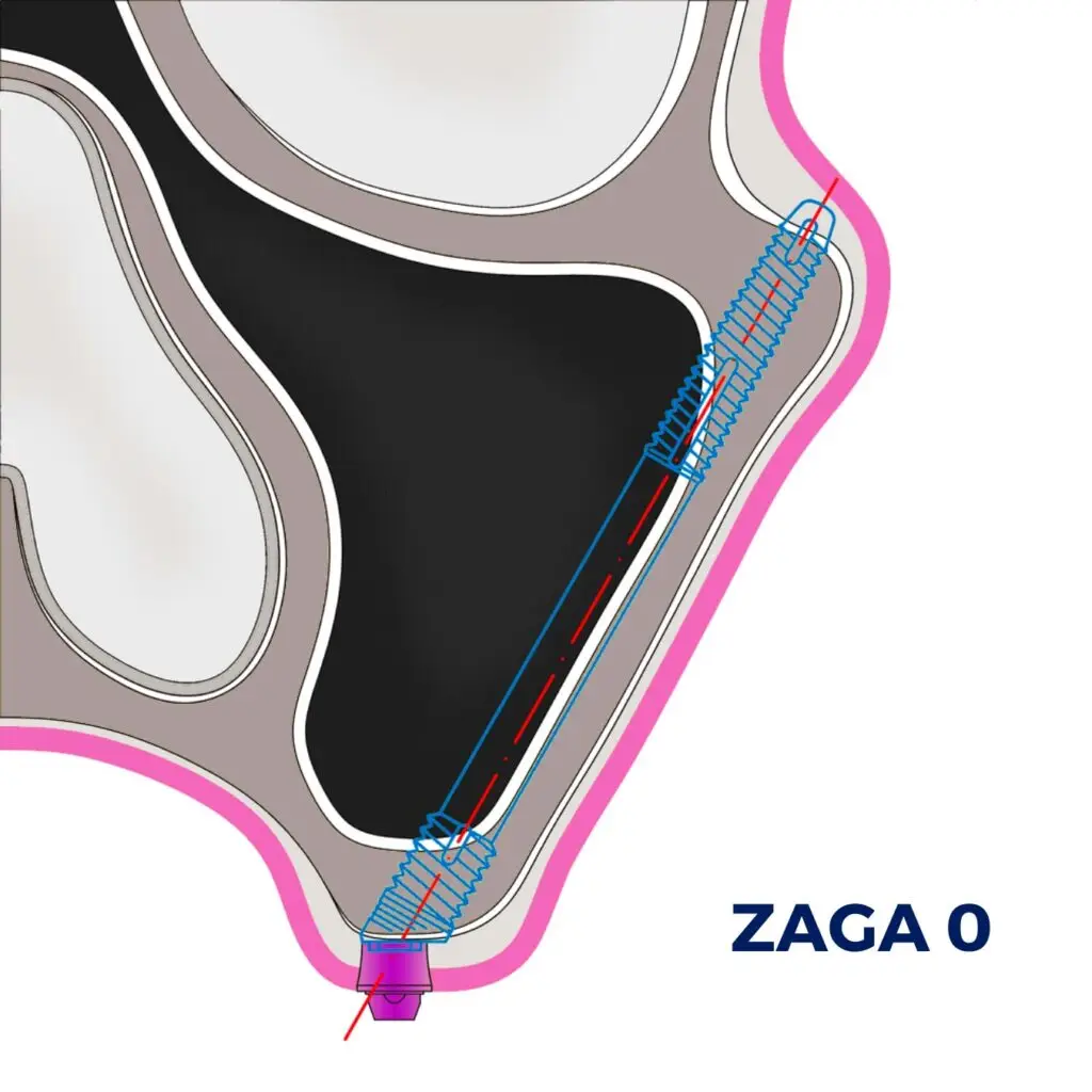 ZAGA Classification Type 0