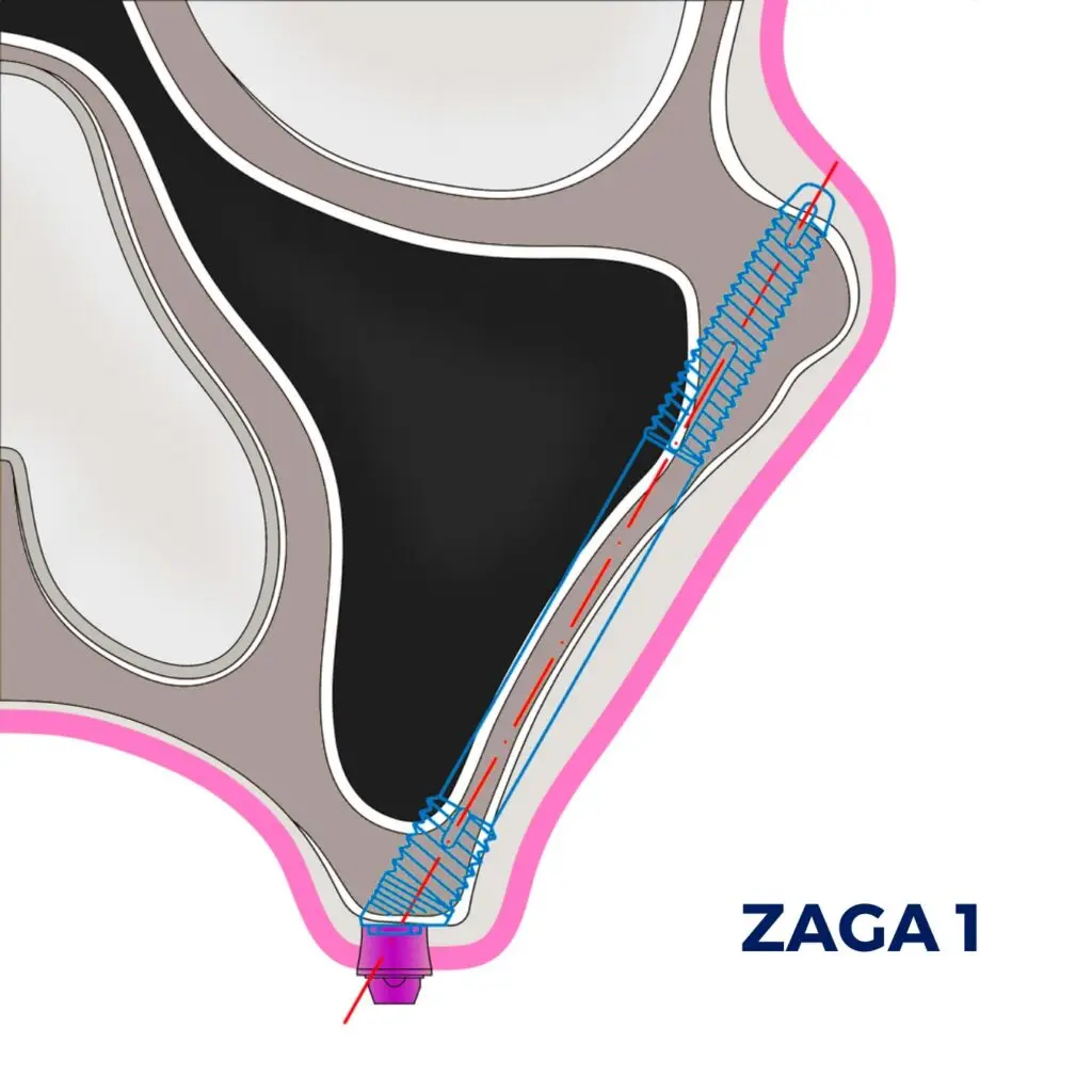 ZAGA Classification Type 1