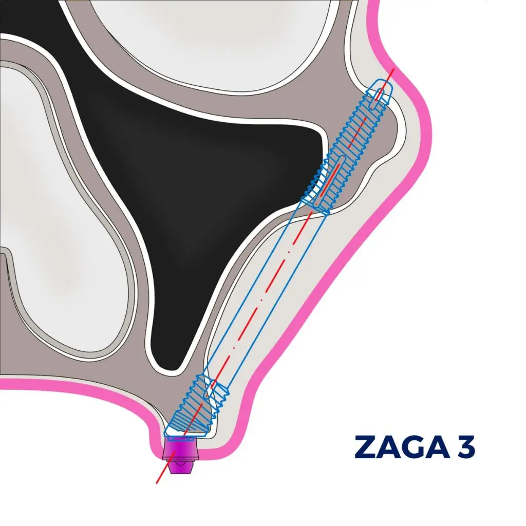 ZAGA Classification Type 3